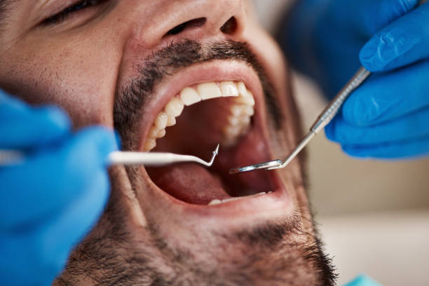 Best Emergency Dentist for Lost Fillings or Crowns in Woodlawn, MD